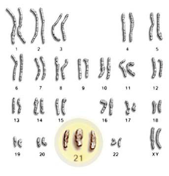 Trisomia 21